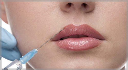 Infiltration of Lips