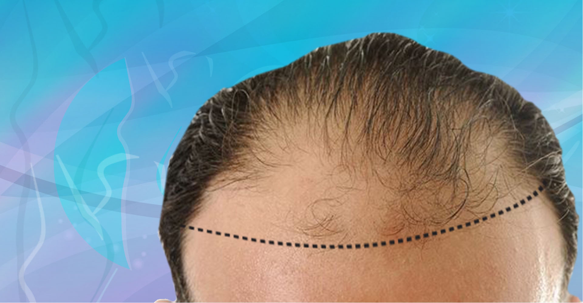 Advance of the Hairline