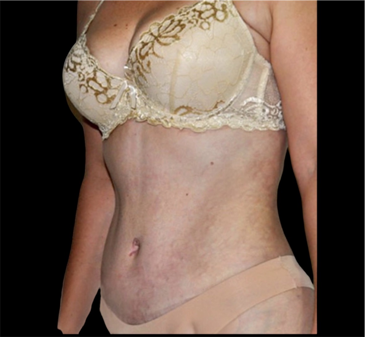 Resultado Abdominoplastia — Dr. Jesús E. Chung