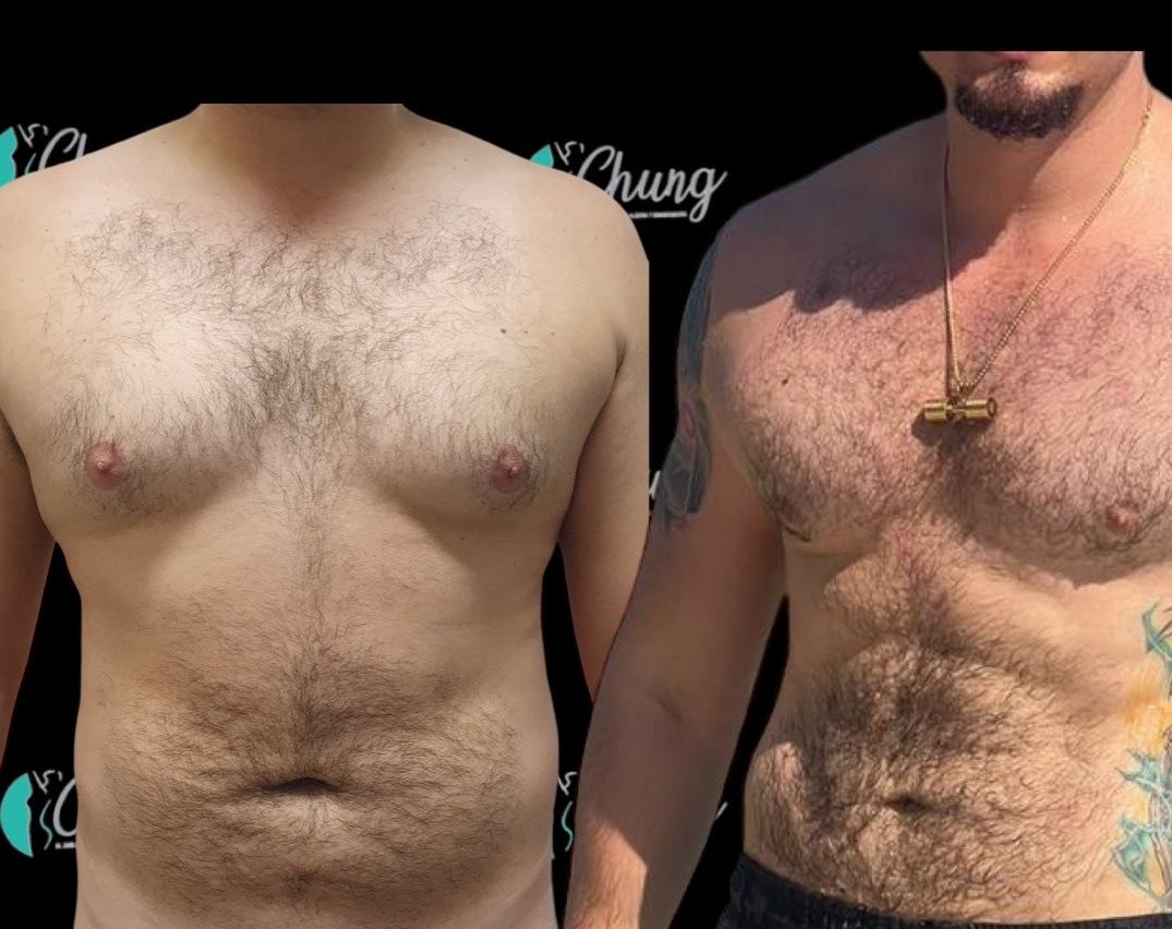 Resultado Ginecomastia — Dr. Jesús E. Chung