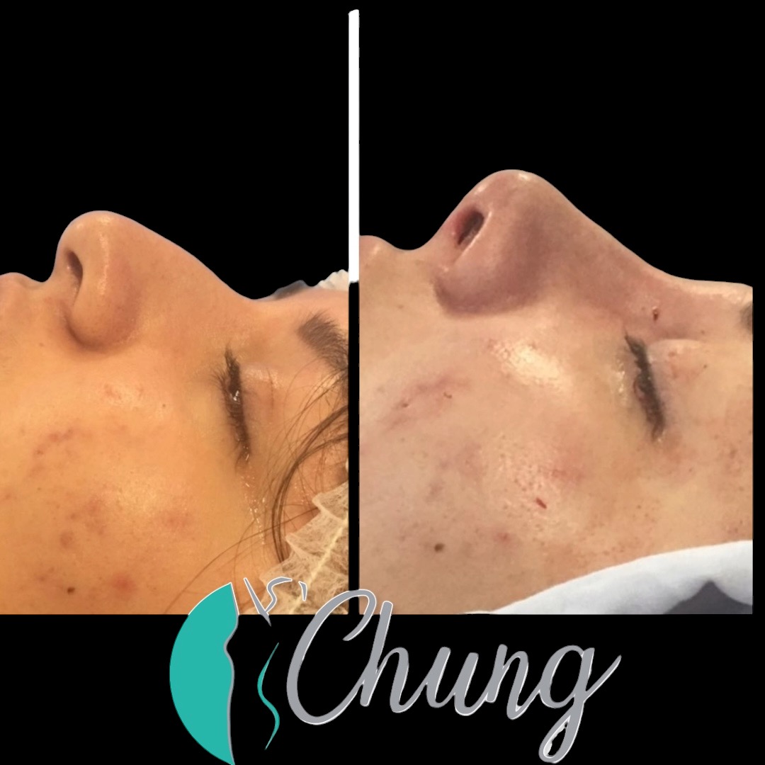 Resultado Rinoplastia — Dr. Jesús E. Chung