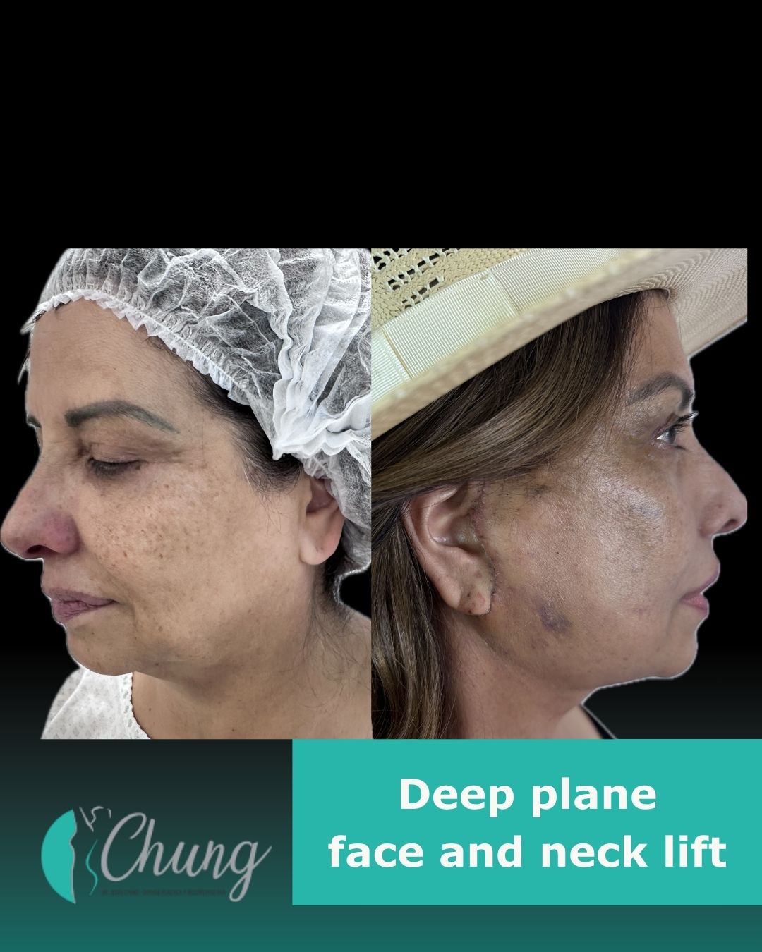 Resultado Lifting Facial — Dr. Jesús E. Chung