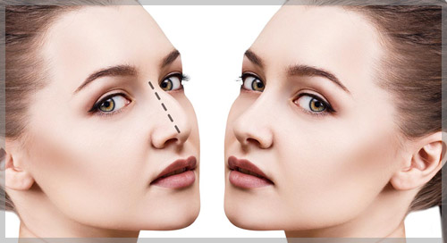 Rinoplastia Dr. Jesús Chung Zapopan